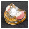金属床義歯 （部分入れ歯）