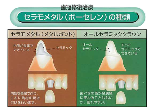 歯冠修復治療