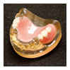 プラスチック義歯 （部分入れ歯）